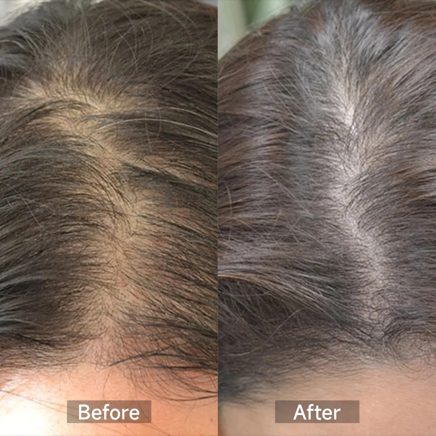 FolliSkin Laser Hair Growth Cap